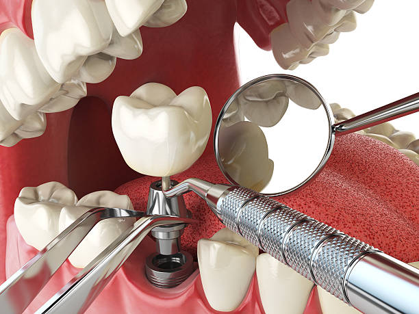 Best Broken or Chipped Tooth Repair in Oakwood Hls, IL